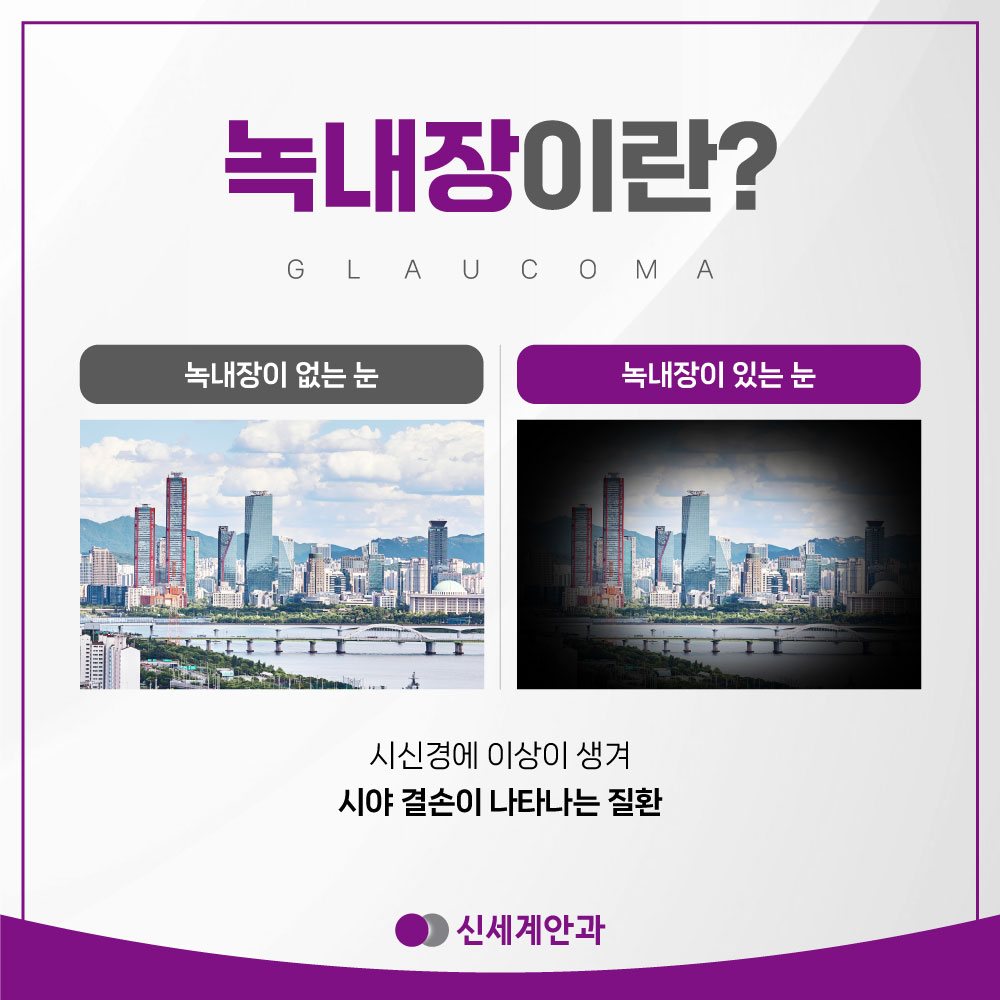 광주녹내장 안내 3