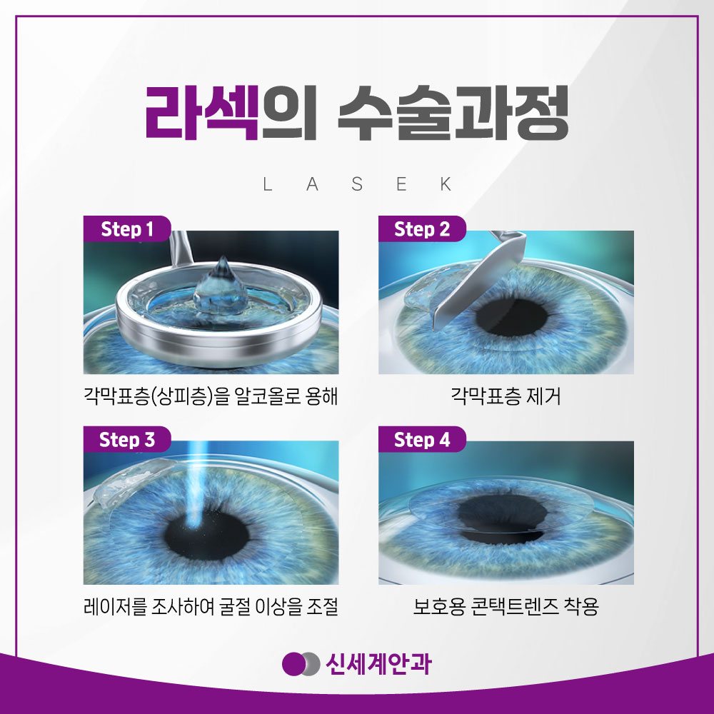 광주라섹 수술과정 4단계