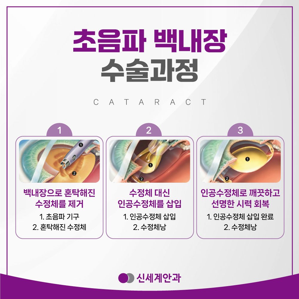 초음파 백내장 수술과정