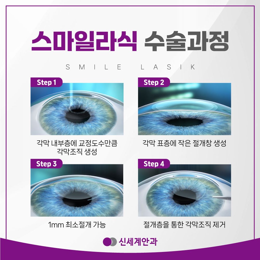 스마일라식 수술과정